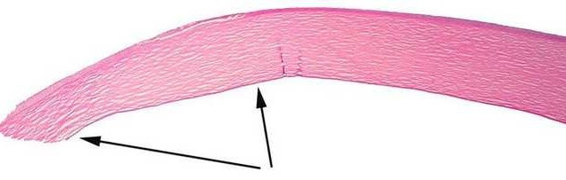 Der Histo Schnitt der Hornhaut zeigt eine Aufquellung und Aufweichung in der unteren Hälfte bei Keratokonus