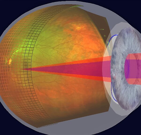Optomap Netzhautaufnahme - Die 3 dimensionale Analyse der Netzhaut erlaubt die Funktionalität der Netzhaut und die zu erwartenede Sehschärfe abzuschätzen.