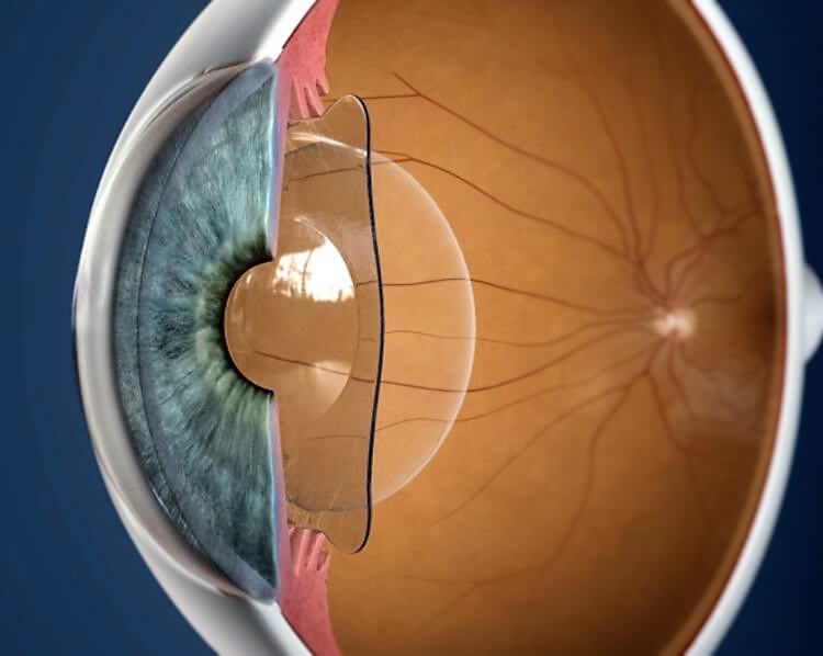 Visian ICL - implantierbare Kontaktlinsen